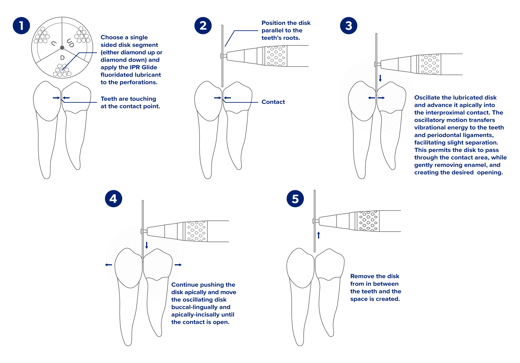 SmartIPR Line Drawing